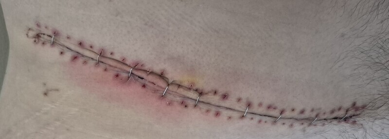 2 jours plus tard, la moitié des agraphes restantes ont été enlevées