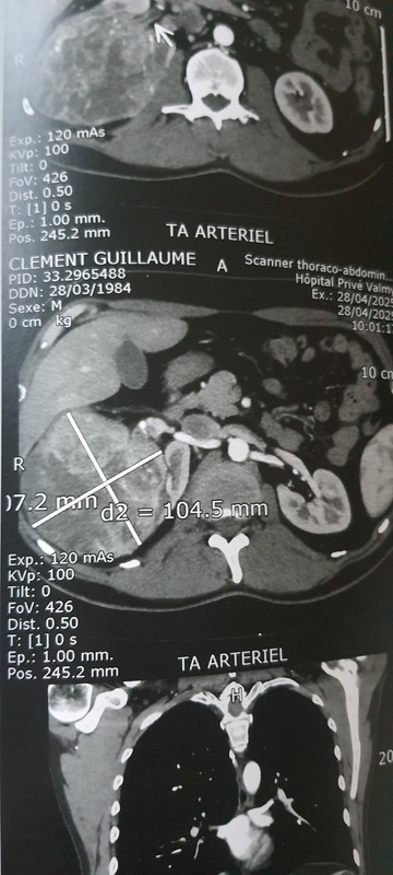 À gauche on voit le rein droit, qui aurait dû ressembler à l'autre, donc à une noix de cajou et pas à un melon