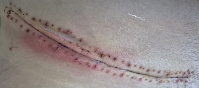 2 jours plus tard, le reste des agraphes a été retiré