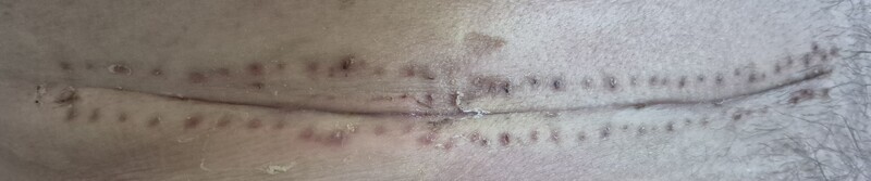 L'hématôme s'était résorbé juste avant de rentrer chez moi