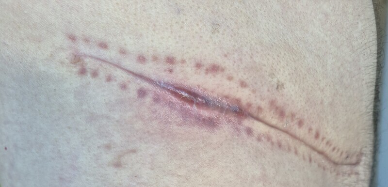 Au bout de 2 semaines, la cicatrice avait regrossi et est restée comme ça.