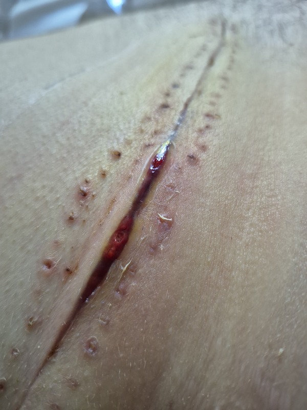 Un hématôme s'était formé sous la cicatrice, qui coulait
